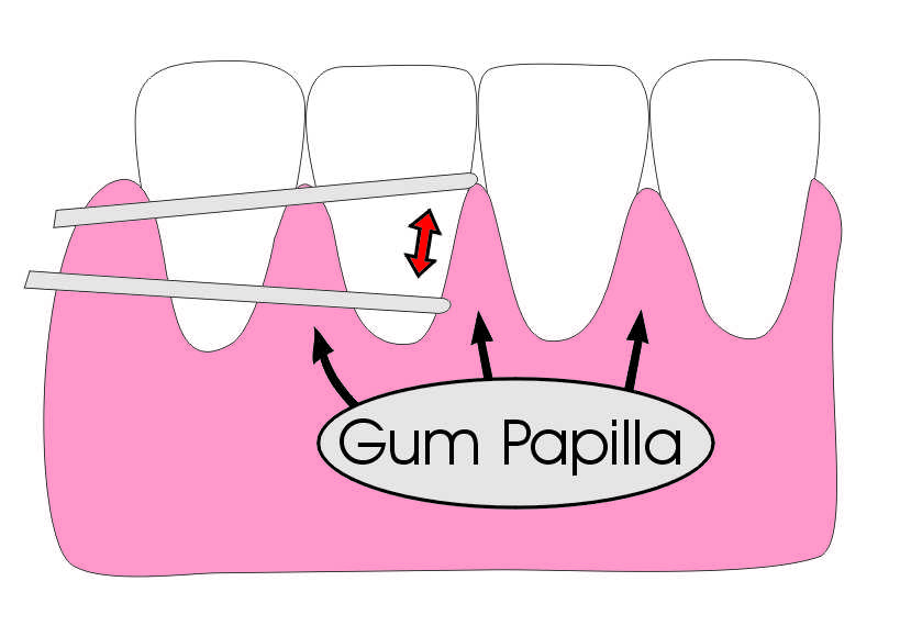 Floss in between your teeth