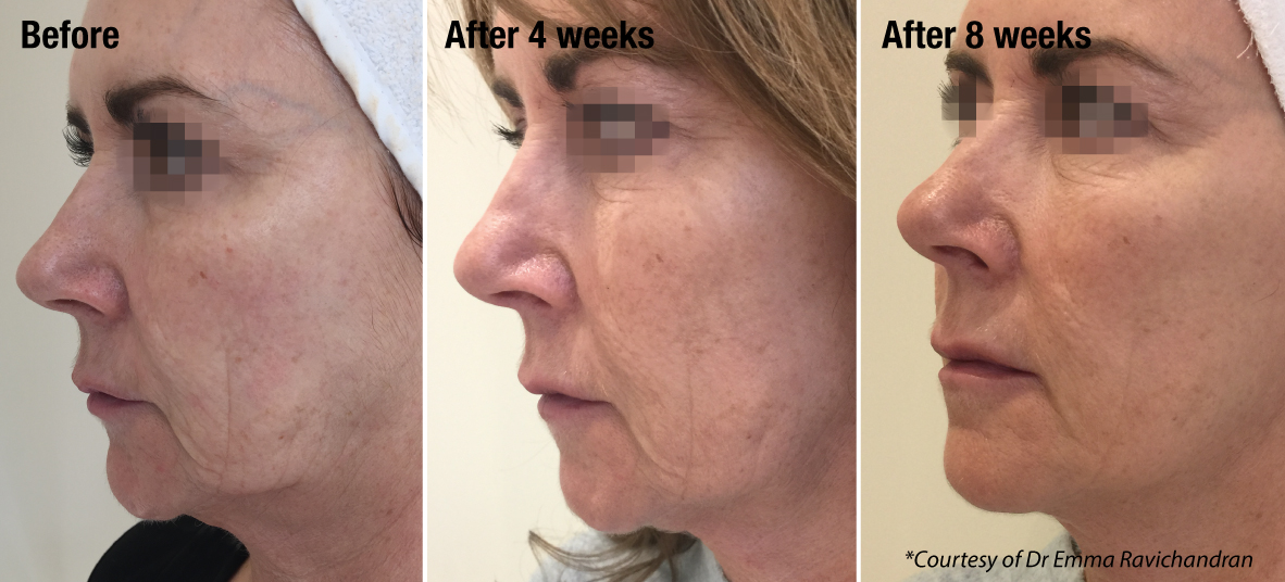 before and after anti-ageing treatment