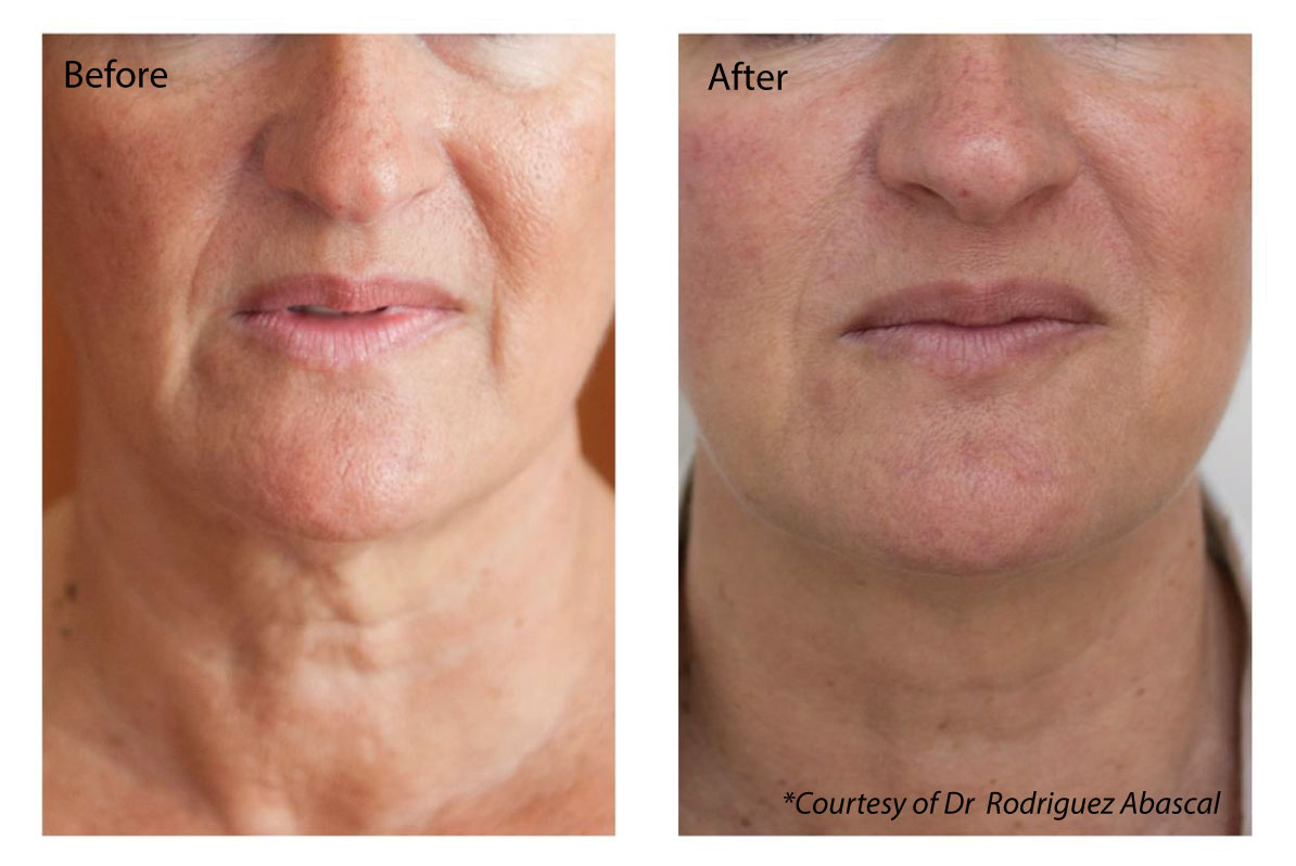 before and after anti-ageing injections