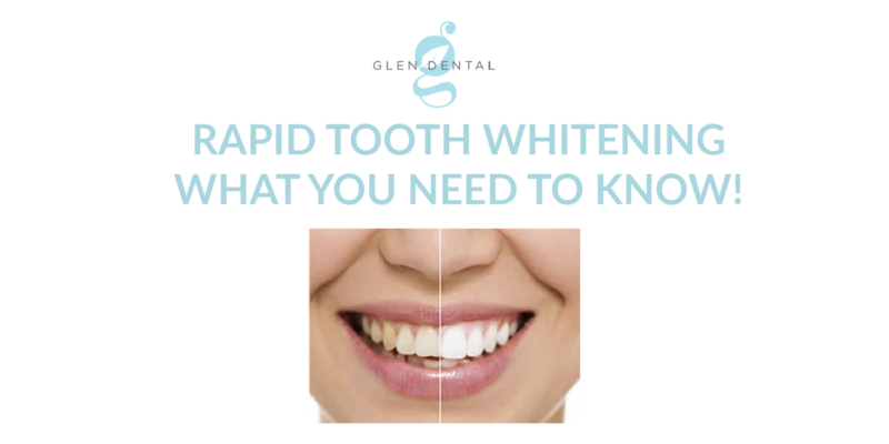 Rapid Tooth Whitening - What You Need to Know! - Glen Dental